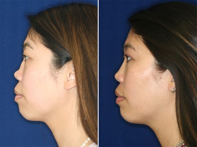 rhinoplasty surgeons near me